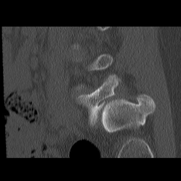 File:Anterolisthesis (Radiopaedia 22226-22263 Sagittal bone window 3).jpg