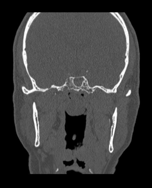 File:Antrochoanal polyp (Radiopaedia 79011-92169 Coronal bone window 12).jpg
