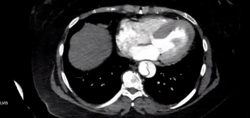 Aortic Dissection (Radiopaedia 85272-100847 A 32).jpg