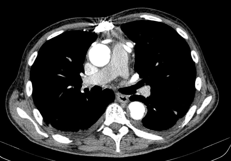 File:Aortic arch saccular aneurysm (Radiopaedia 19430-19457 B 18).jpg