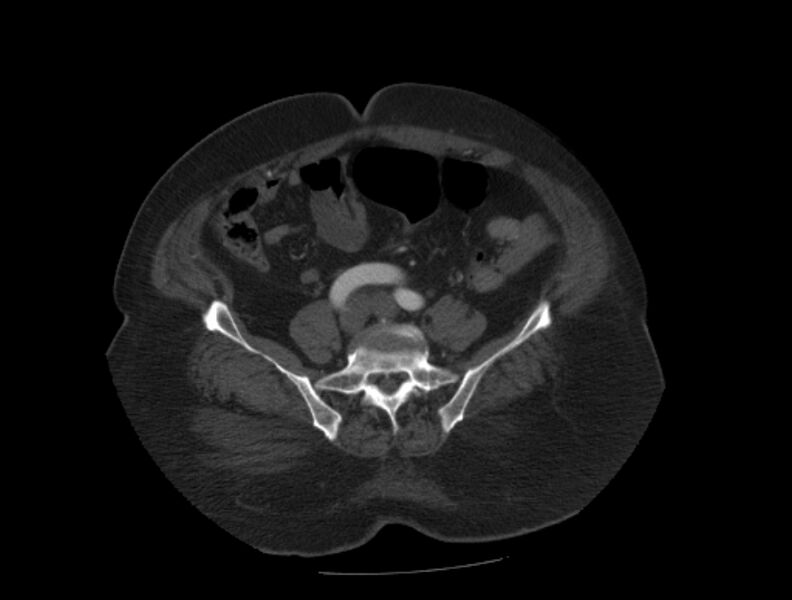 File:Aortic dissection (Radiopaedia 28802-29105 A 81).jpg