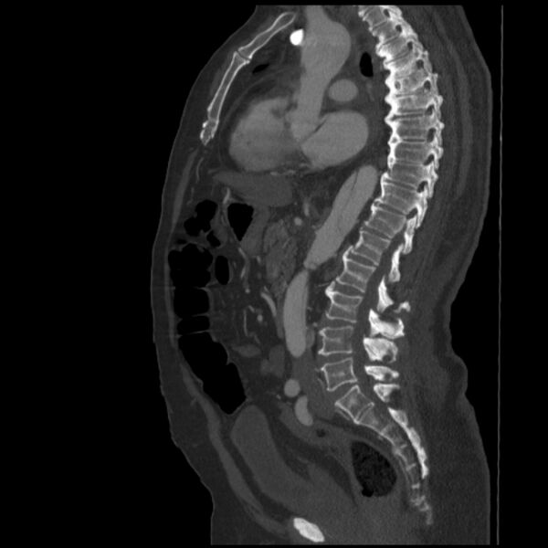 File:Aortic dissection (Radiopaedia 28802-29105 C 23).jpg