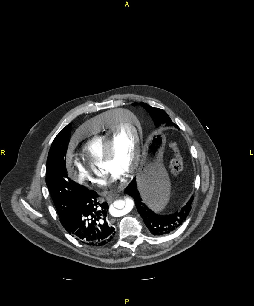 Aortic rupture (Radiopaedia 88822-105594 B 168).jpg