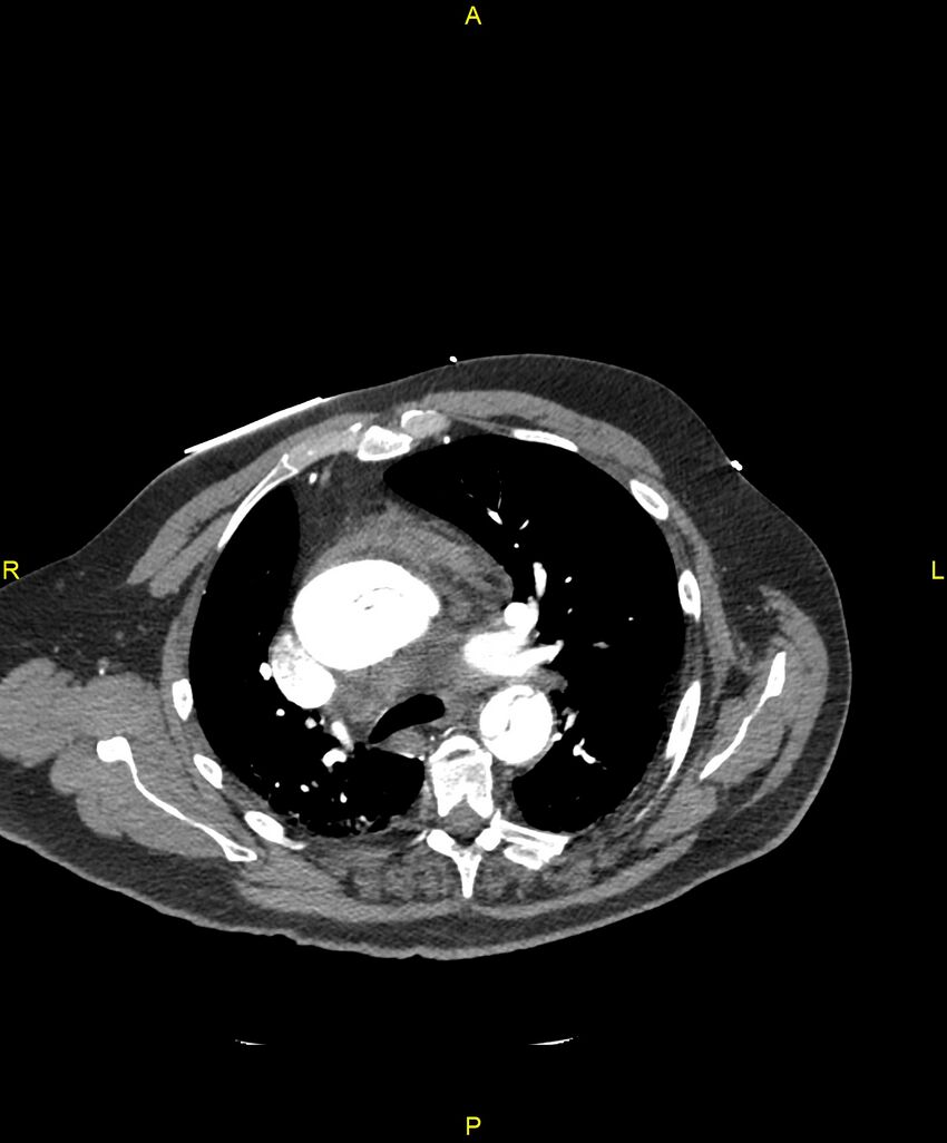 Aortic rupture (Radiopaedia 88822-105594 B 88).jpg