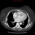 Aortic valve stenosis (Radiopaedia 14480-14423 C 11).jpg