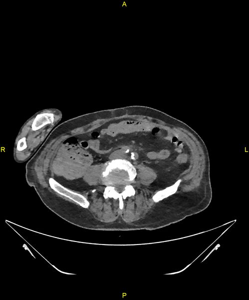 File:Aortoenteric fistula (Radiopaedia 84308-99603 Axial non-contrast 232).jpg