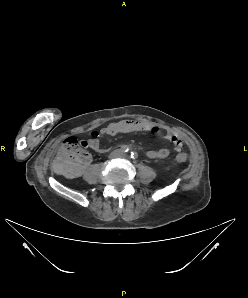 Aortoenteric fistula (Radiopaedia 84308-99603 Axial non-contrast 232).jpg