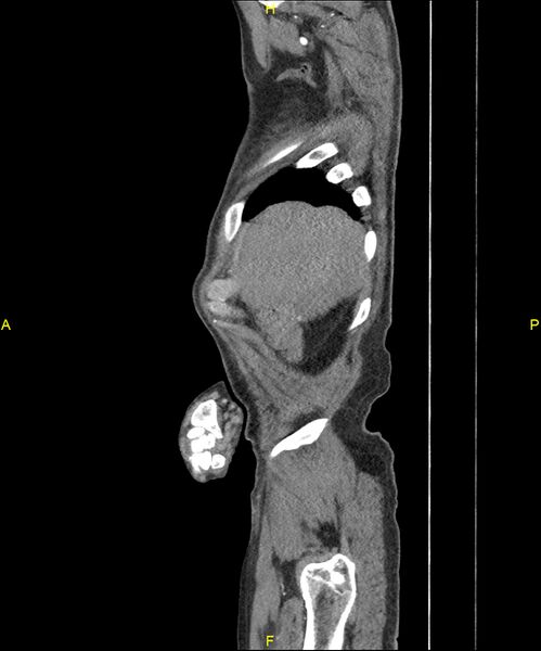 File:Aortoenteric fistula (Radiopaedia 84308-99603 C 35).jpg