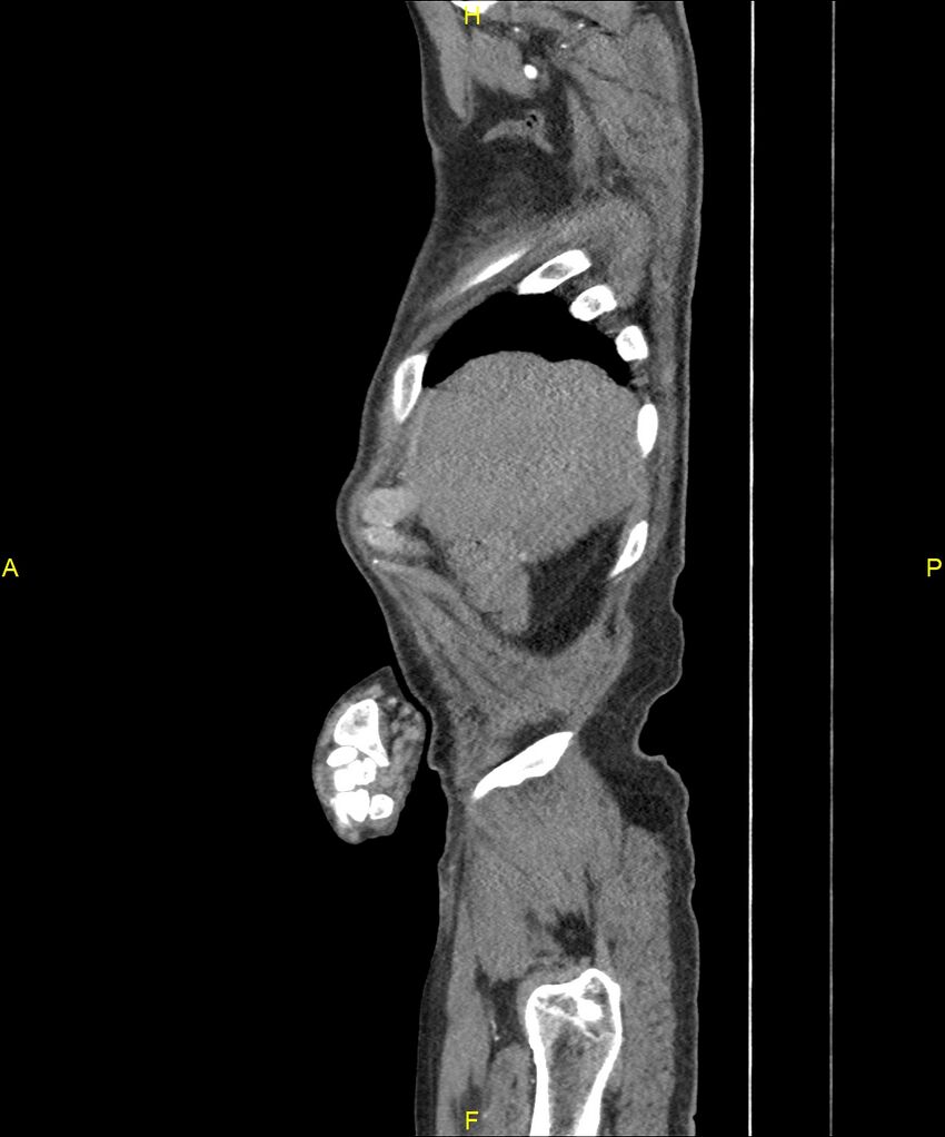 Aortoenteric fistula (Radiopaedia 84308-99603 C 35).jpg