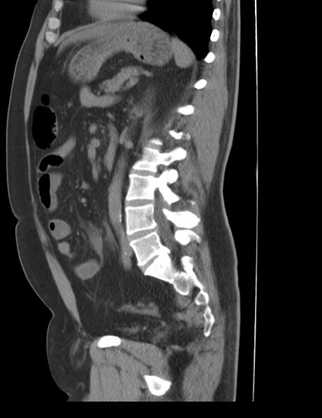 File:Appendicitis and giant appendicolith (Radiopaedia 80251-93588 C 23).jpg