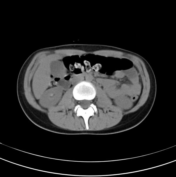 File:Appendicitis and incidental bicornuate uterus (Radiopaedia 22833-22853 Axial non-contrast 20).jpg