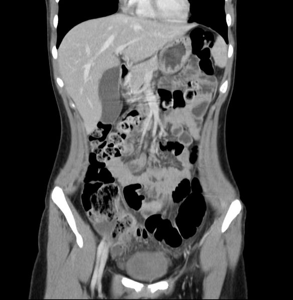File:Appendicitis and incidental bicornuate uterus (Radiopaedia 22833-22853 D 12).jpg