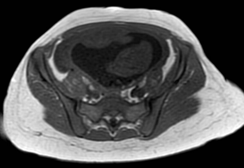 File:Appendicitis in gravida (MRI) (Radiopaedia 89433-106395 Axial T1 in-phase 51).jpg