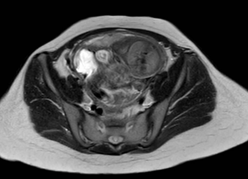 File:Appendicitis in gravida (MRI) (Radiopaedia 89433-106395 Axial T2 54).jpg