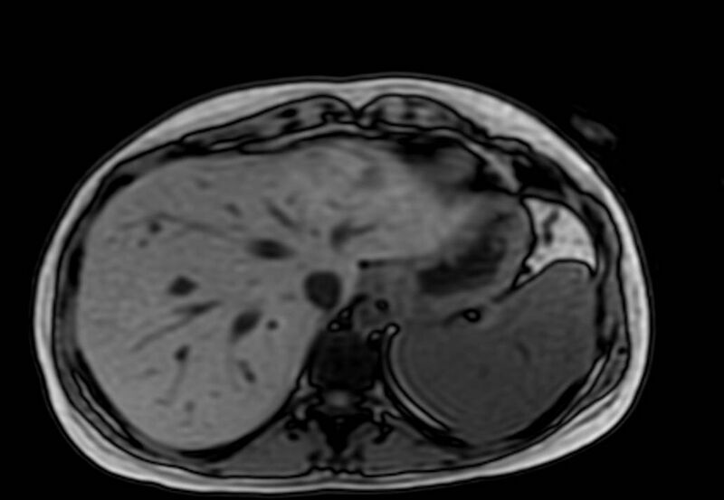 File:Appendicitis in gravida (MRI) (Radiopaedia 89433-106395 D 6).jpg