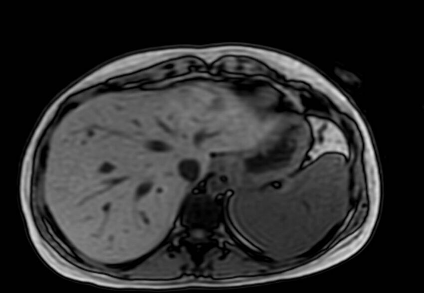 Appendicitis in gravida (MRI) (Radiopaedia 89433-106395 D 6).jpg
