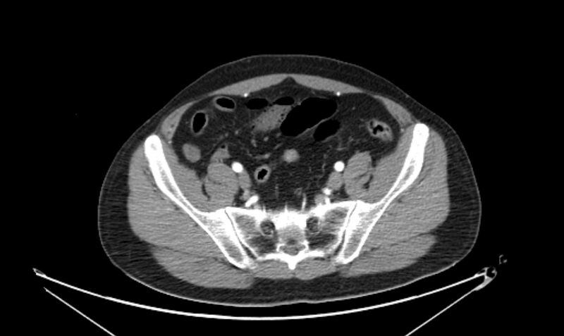 File:Arterial occlusive mesenteric ischemia (Radiopaedia 84641-100060 A 103).jpg