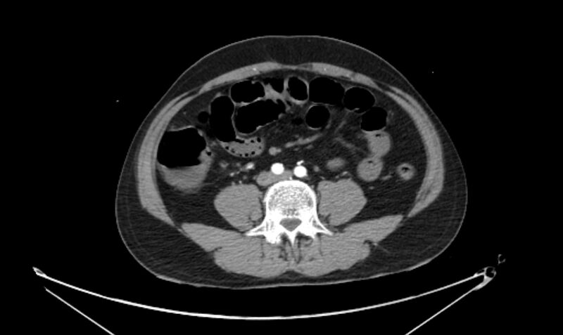 File:Arterial occlusive mesenteric ischemia (Radiopaedia 84641-100060 A 82).jpg