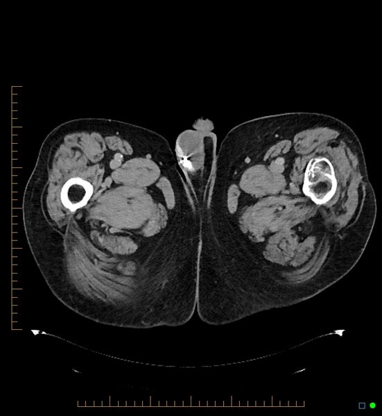 File:Artificial urethral sphincter (Radiopaedia 46937-51464 A 20).jpg