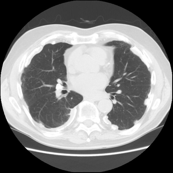 File:Asbestos-related pleural plaques (Radiopaedia 39069-41255 Axial lung window 41).jpg