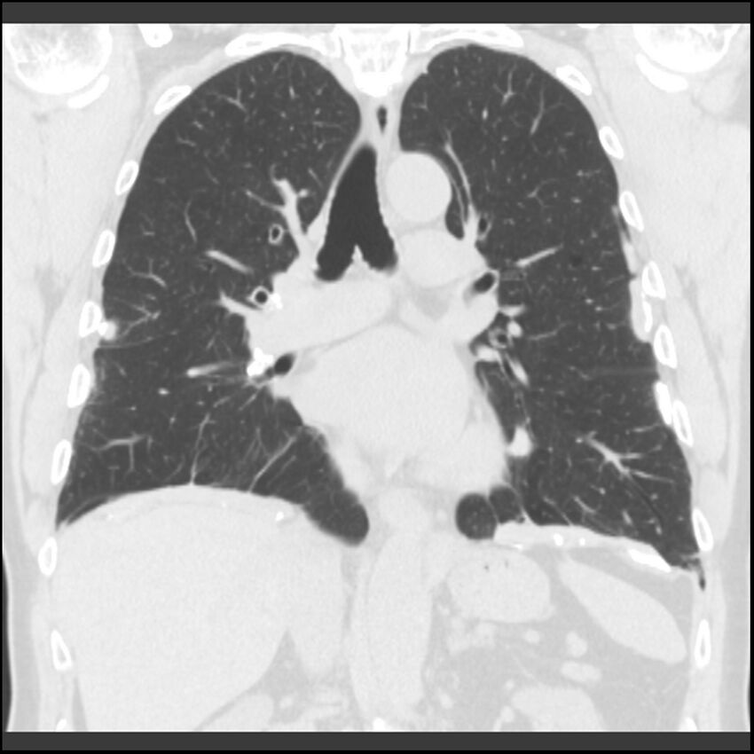 Asbestos-related pleural plaques (Radiopaedia 39069-41255 Coronal lung window 43).jpg