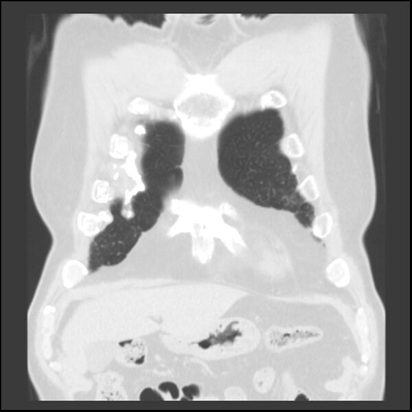 File:Asbestos-related pleural plaques (Radiopaedia 39069-41255 Coronal lung window 76).jpg