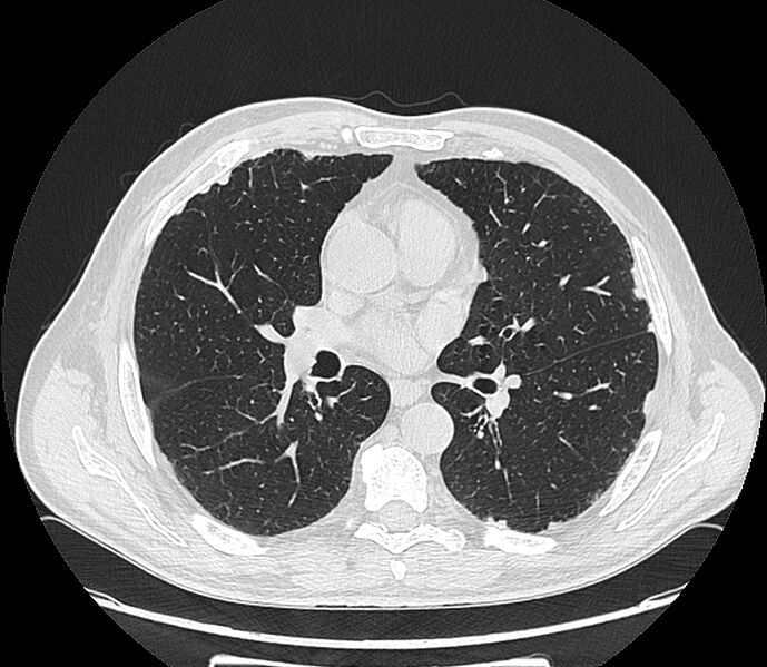 File:Asbestos pleural placques (Radiopaedia 57905-64872 Axial lung window 126).jpg