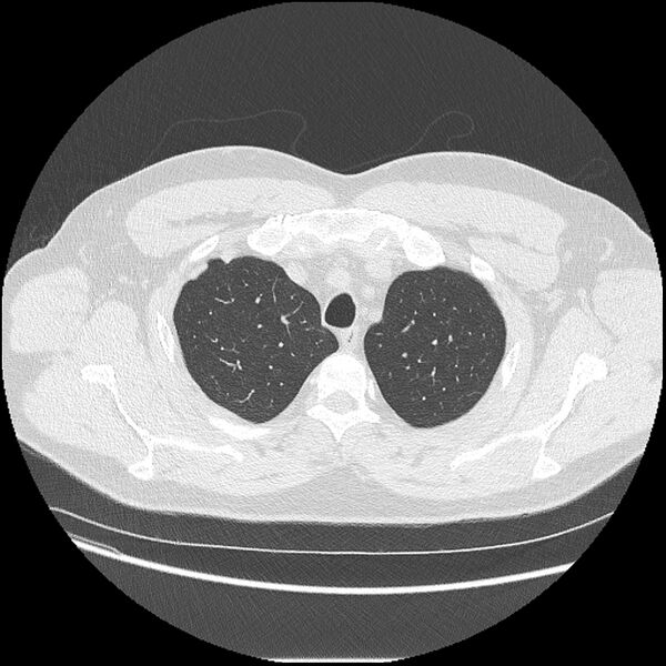 File:Asbestosis (Radiopaedia 45002-48961 Axial lung window 8).jpg