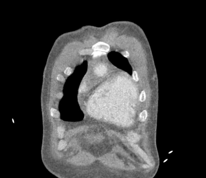 File:Ascending aortic aneurysm (Radiopaedia 86279-102297 B 3).jpg
