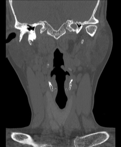 File:Atlanto-occipital assimilation with basilar invagination (Radiopaedia 70122-80188 Coronal bone window 24).jpg