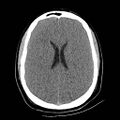 Atlanto-occipital dislocation (Radiopaedia 44648-48412 Axial non-contrast 35).jpg