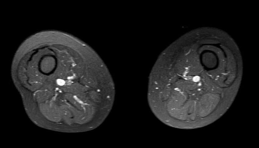 Atypical lipomatous tumor - thigh (Radiopaedia 68975-78734 Axial PD fat sat 36).jpg