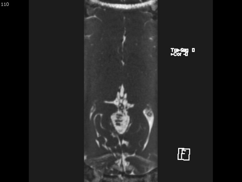 File:Atypical meningioma - intraosseous (Radiopaedia 64915-74572 Axial CISS 110).jpg