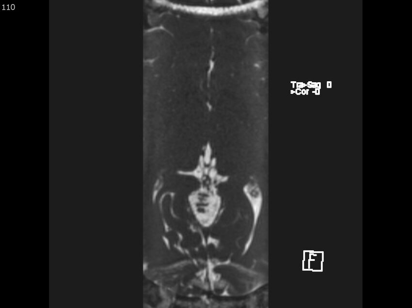 Atypical meningioma - intraosseous (Radiopaedia 64915-74572 Axial CISS 110).jpg
