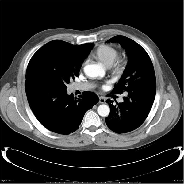 File:Atypical pneumonia - Q fever (Radiopaedia 21993-21989 C+ arterial phase 25).jpg