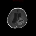 Atypical teratoid rhabdoid tumor (Radiopaedia 10712-11183 Axial T1 C+ 6).jpg