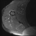 Avulsion fracture - greater tuberosity of humerus (Radiopaedia 71216-81515 Axial PD fat sat 1).jpg