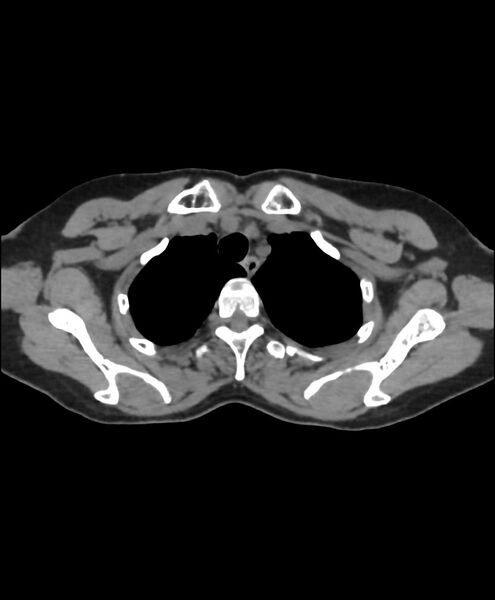 File:Azygos fissure and azygos lobe (Radiopaedia 41841-44832 Axial non-contrast 9).jpg