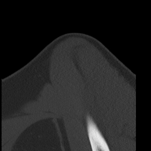 File:Bankart lesion (Radiopaedia 22771-22798 Sagittal bone window 1).jpg