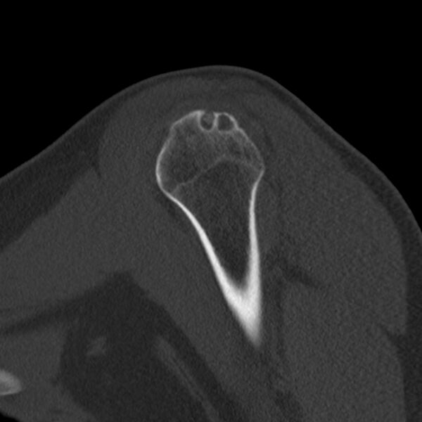 File:Bankart lesion (Radiopaedia 22771-22798 Sagittal bone window 12).jpg
