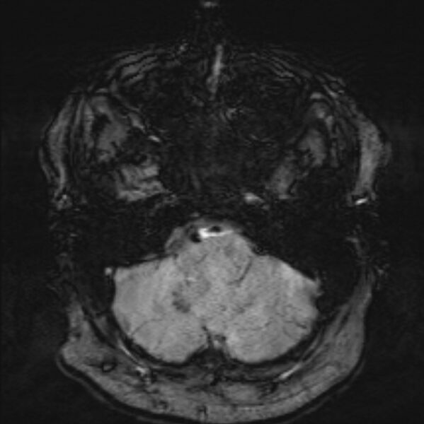 File:Basilar artery dissection (Radiopaedia 77032-88976 Axial SWI 10).jpg
