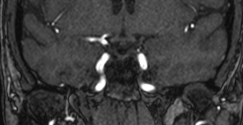 File:Basilar artery fenestration (Radiopaedia 74537-85455 Coronal MRA TOF 22).jpg