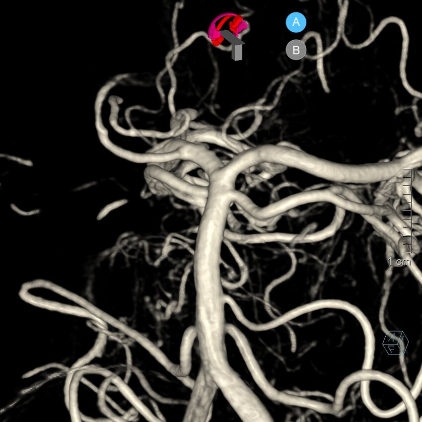 Basilar artery perforator aneurysm (Radiopaedia 82455-97734 3D view left VA 107).jpg