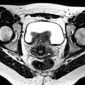 Bicornuate uterus (Radiopaedia 11104-11492 Axial T2 16).jpg
