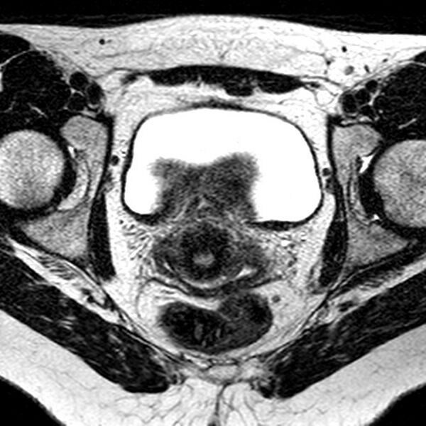 File:Bicornuate uterus (Radiopaedia 11104-11492 Axial T2 16).jpg