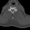 Bilateral C6-7 locked facet dislocation (Radiopaedia 28506-28748 Axial bone window 14).jpeg