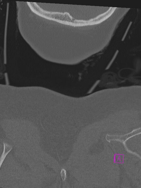 File:Bilateral atlanto-occipital assimilation (Radiopaedia 28350-28603 Coronal bone window 63).jpg