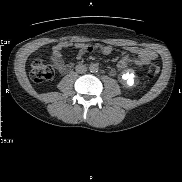 File:Bilateral medullary nephrocalcinosis with ureteric calculi (Radiopaedia 71269-81569 Axial non-contrast 66).jpg