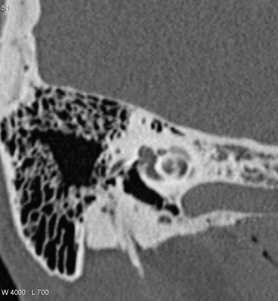 File:Bilateral otosclerosis with left stapes prosthesis (Radiopaedia 5567-7302 Coronal bone window 8).jpg