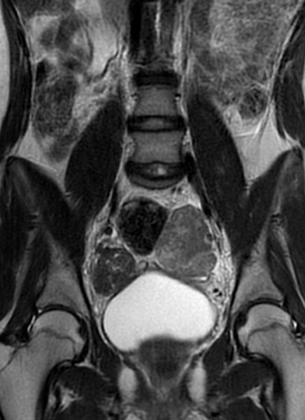 File:Bilateral ovarian fibrothecomas - adolescent (Radiopaedia 86604-102707 Coronal T2 18).jpg